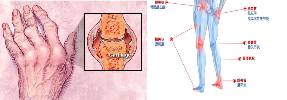 關節疼痛？骨痛？是不是得了類風濕性關節炎？